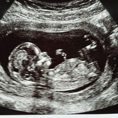 kinesiologie enceinte, échographie bébé